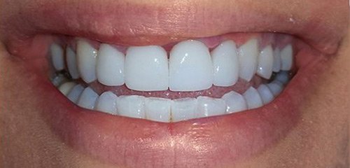 After Philips Zoom! Whitening